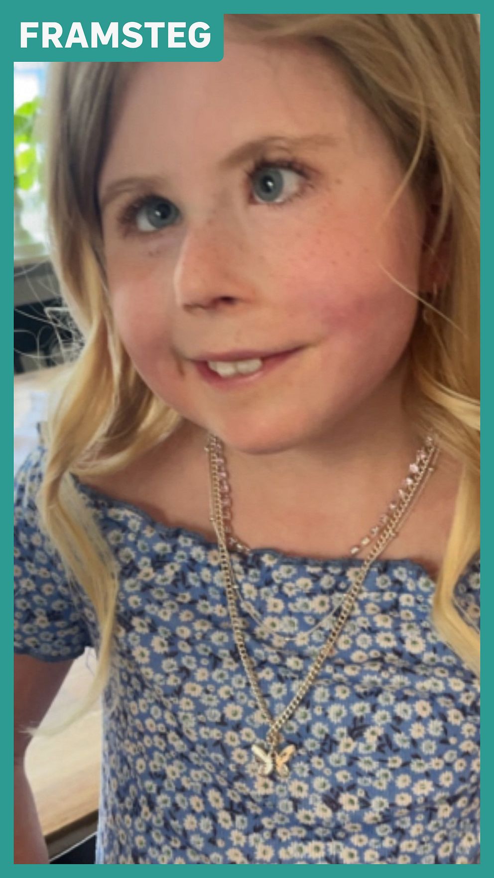 Lovis Sjöblom, 10 år, i blommig klänning efter operation för ansiktsförlamning.