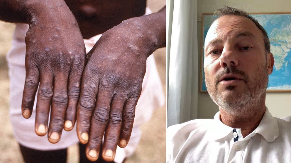 Händer på person smittad av mpox