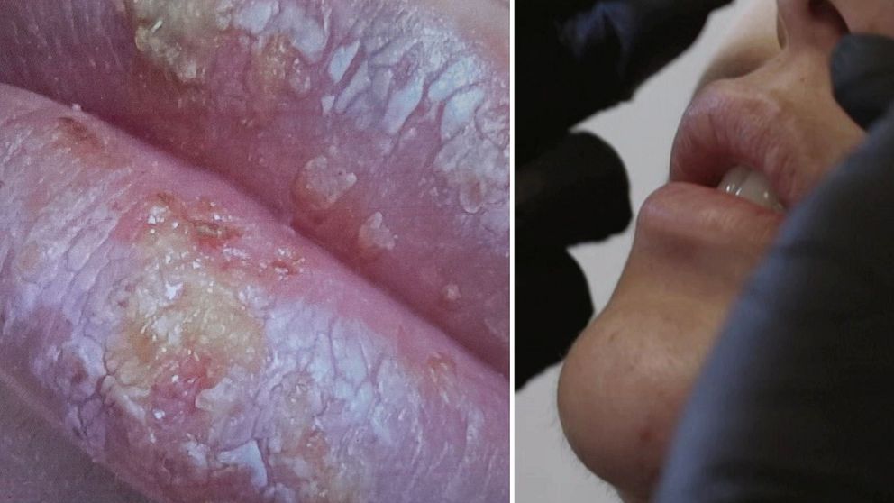 Delad bild. Såriga läppar till vänster. En bild på en som gör fillers.
