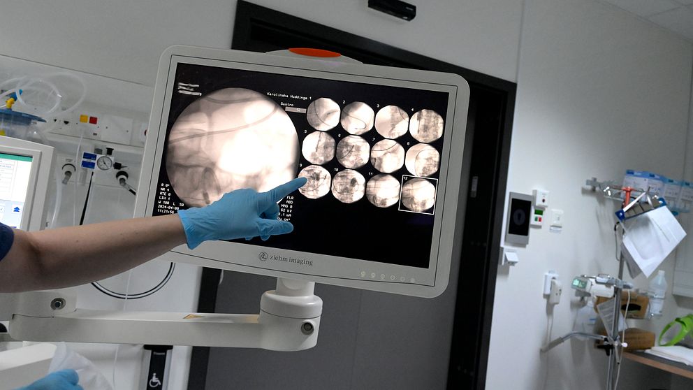 En sjukvårdspersonal pekar på en medicinsk bildskärm som visar röntgenbilder av insidan av en patients kropp, med flera olika sektioner för analysering. Skärmen är placerad i ett sjukhusrum.