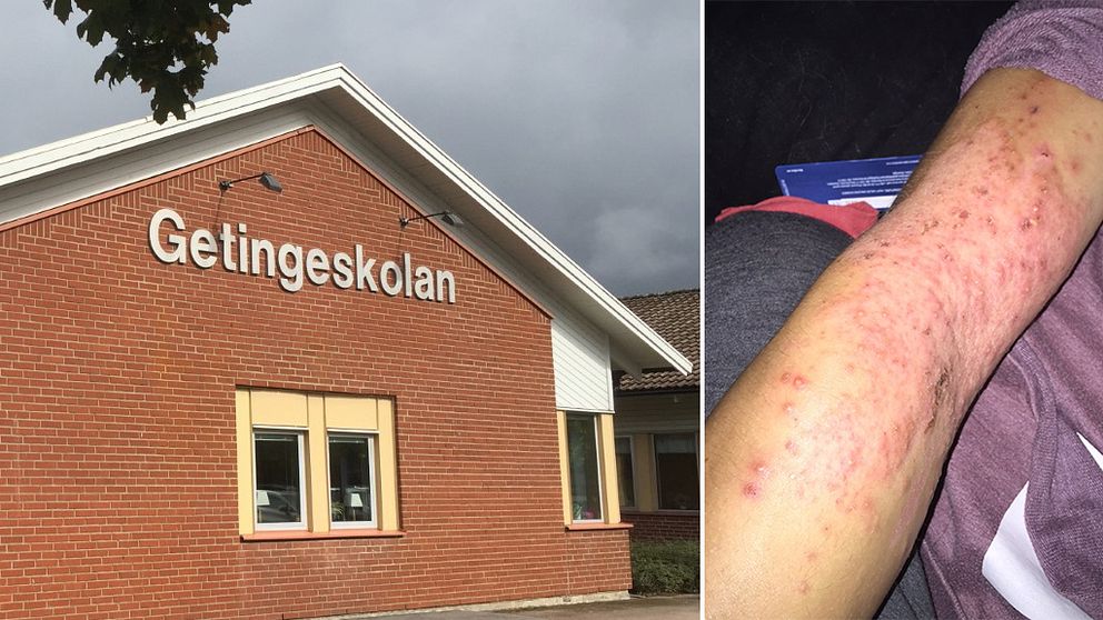 Getingeskolan och arm med kraftigt eksem