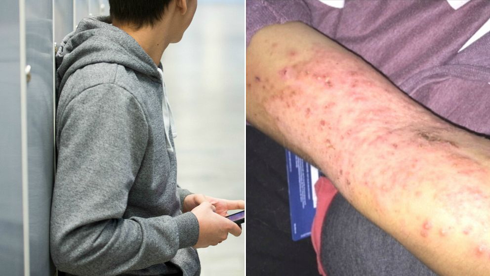 Flera elever på Getingeskolan har fått allergiproblem.