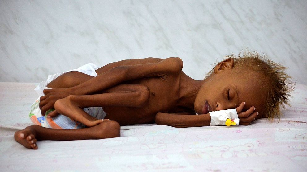 En sexårig pojke vårdas för näringsbrist på ett sjukhus i Jemen.