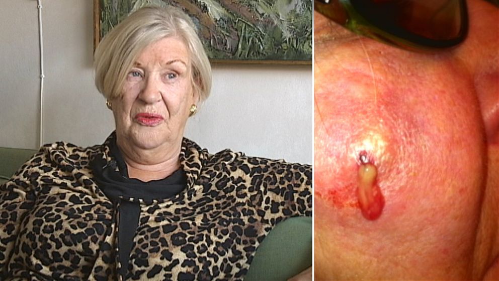 Margareta Nystrand drabbas av en allergisk reaktion efter ingreppet