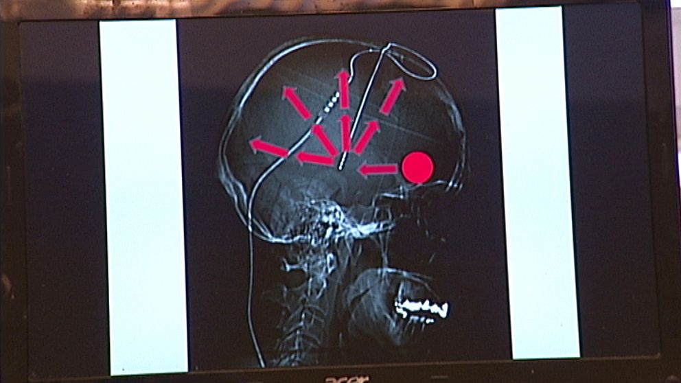 röntgenbild av skalle och elektrod, pilar symboliserar elpulser