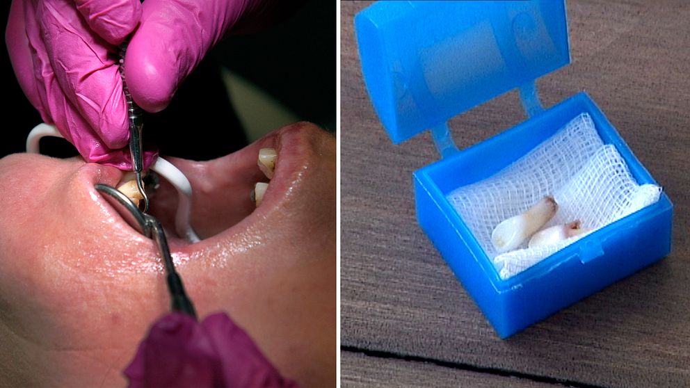 Tandlös patient och lösa tänder