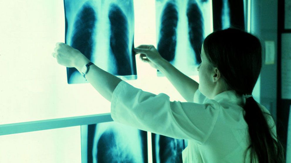 Skillnaden stor i överlevnad i lungcancer