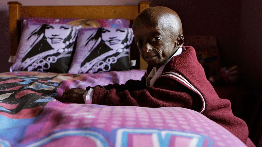 Sydafrikanska Ontlametse Phalatse är ett av barnen som lider av sjukdomen progeria.