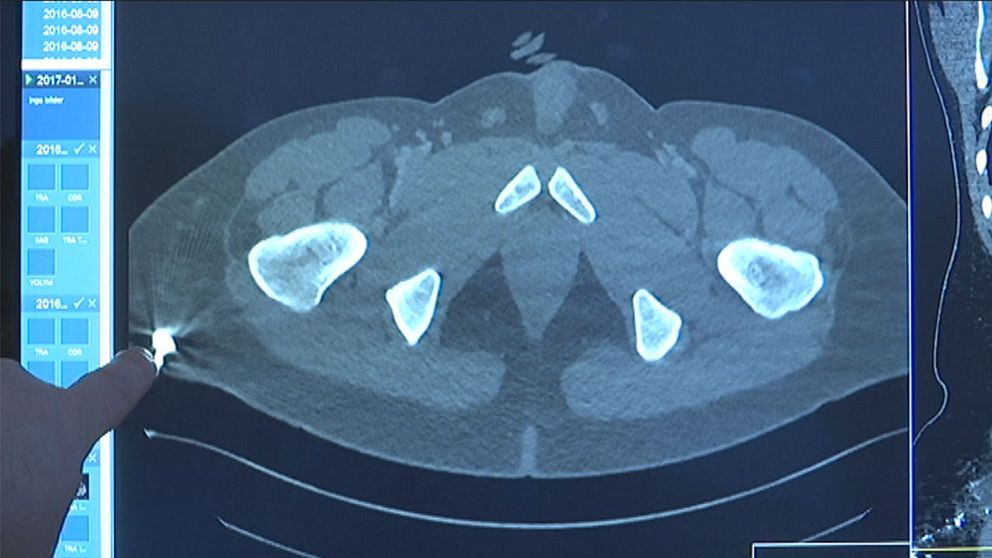 Röntgenbild: Här har kukan fastnat i lungan