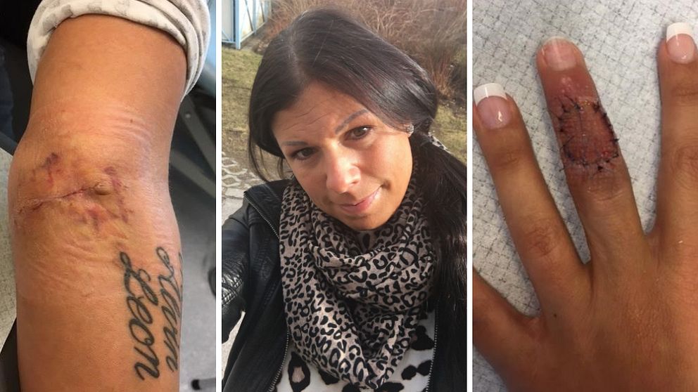 Madelene Jeppson skulle ta bort en tatuering på fingret – salongen använde syra.