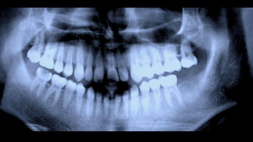 Tandröntgen är en av metoderna som använts för att åldersbestämma flyktingar.