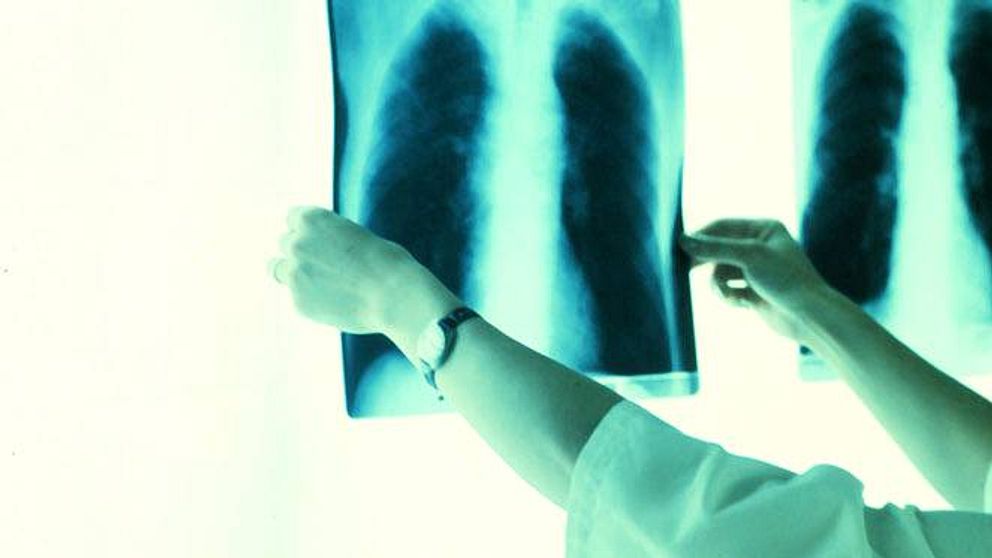 Röntgenbilder på lungor