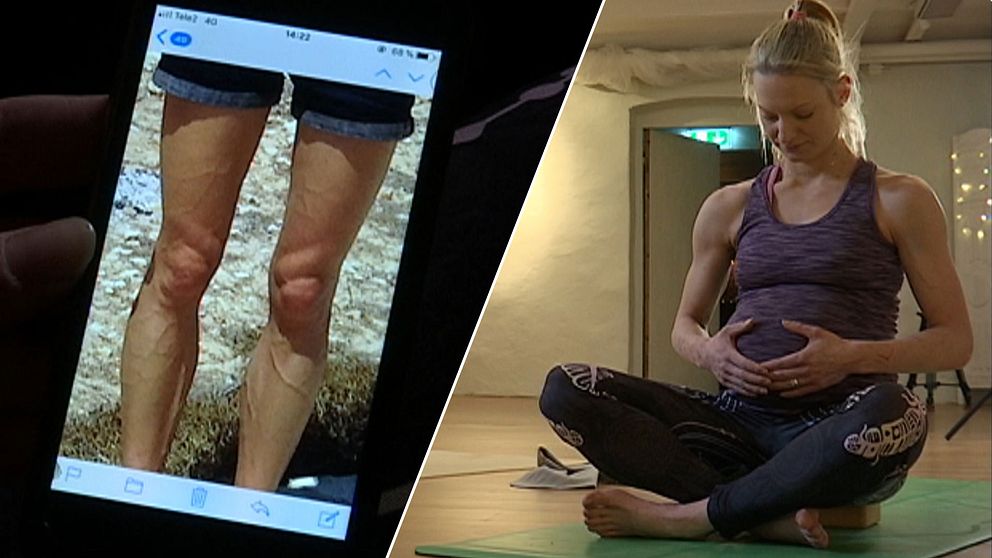 Bild på ben med synliga ådror och gravid kvinna som sitter i yoga-ställning.