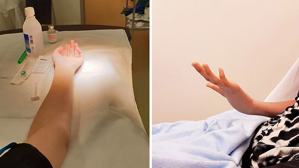 Bilder på handen före och efter karpartunnelklyvningen