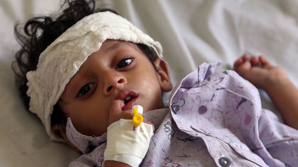 Ett barn i Jemen med bandage runt huvudet behandlas för undernäring.