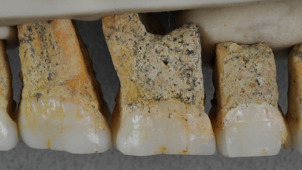 Dessa tänder tillhörde en av de människor vars rester man nu hittat.