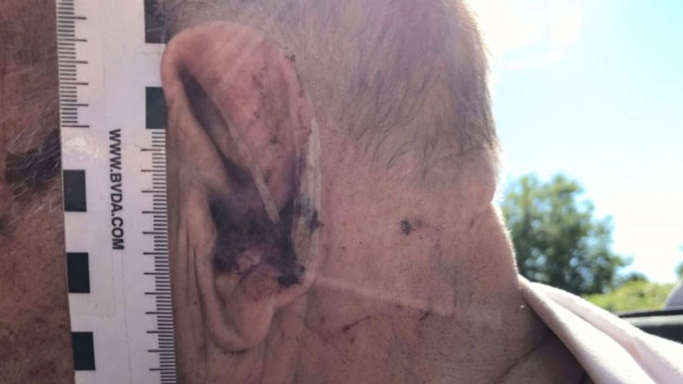 En äldre mans öra som är blodigt och delvis tejpat. Mot mannens huvud ligger en linjal från polisens undersökning.