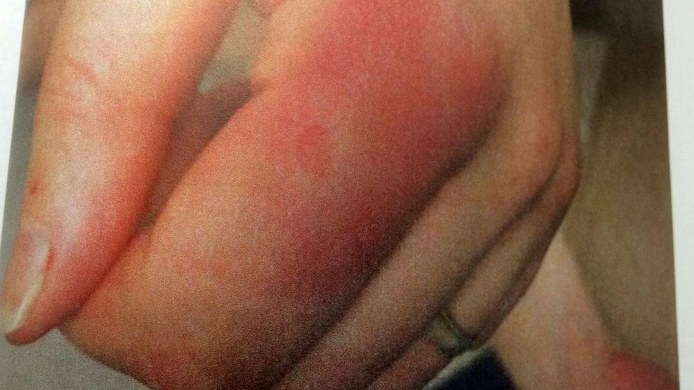 Den mordåtalade kvinnans vänsterhand med tydliga rodnader.