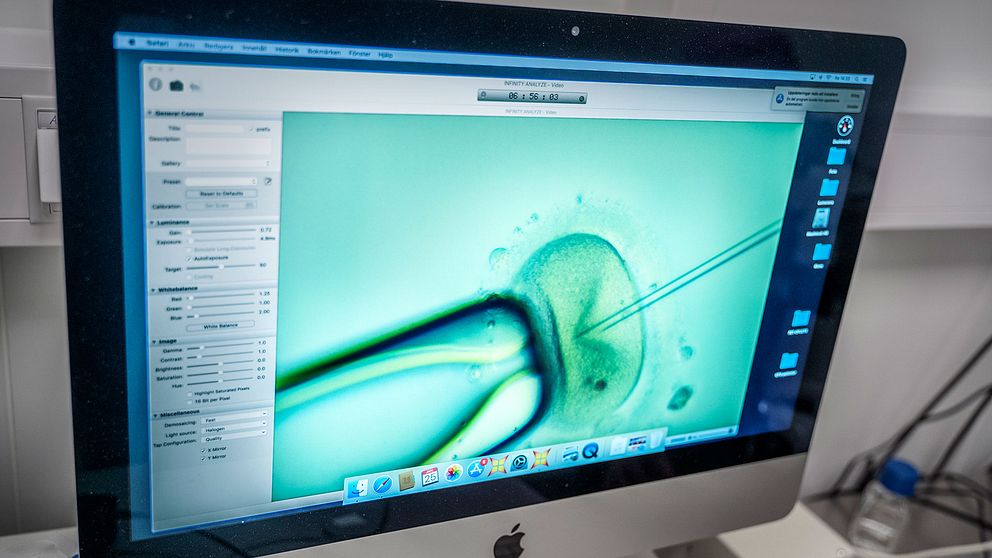 Ett ägg blir befruktat vid IVF-klinik i Stockholm.
