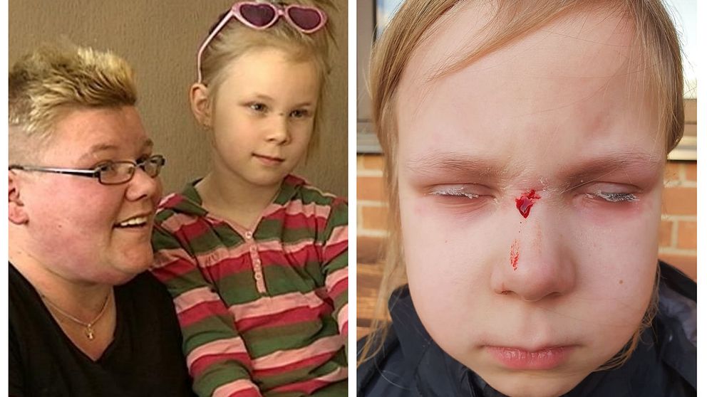 Amelias ögon limmades ihop när ett sår skulle behandlas.
