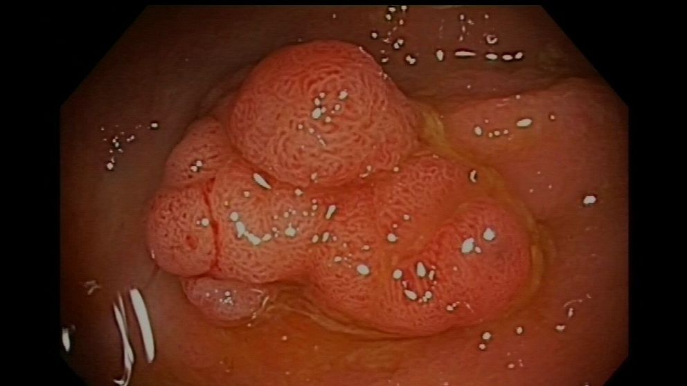 Bild av en polyp i tjocktarmen från en endoskopisk undersökning.