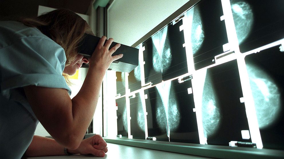 Läkare granskar röntgenbilder från mammografi