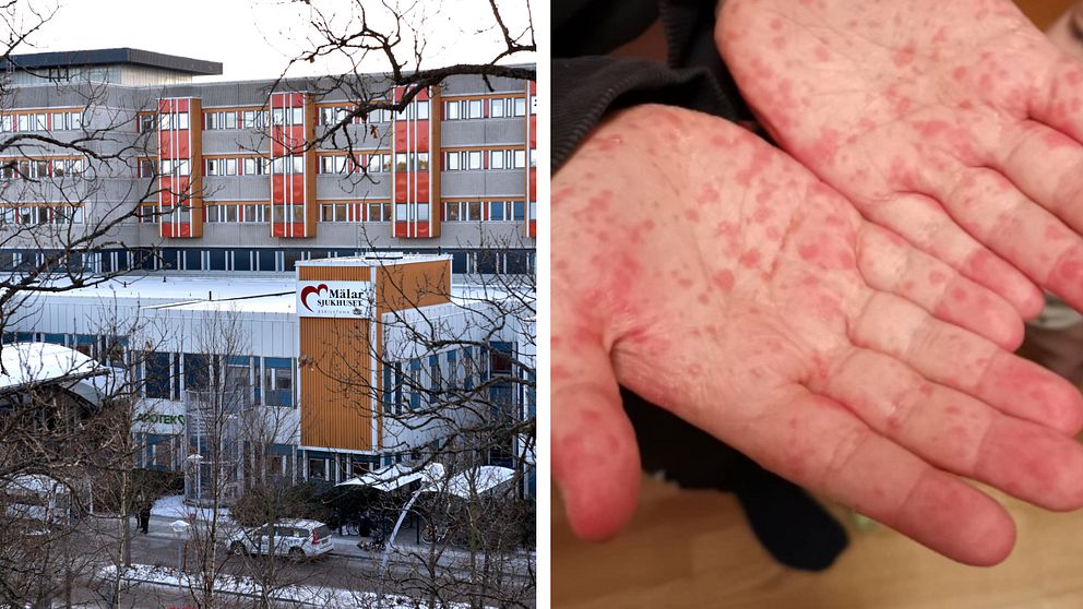 Fyra barn med det som tros vara den ovanliga men allvarliga sjukdomen MIS-C har hittills vårdats på sjukhus i Sörmland. I klippet ovan berättar Diana Bornstein, chef på barn- och ungdomskliniken, om hur det har varit.