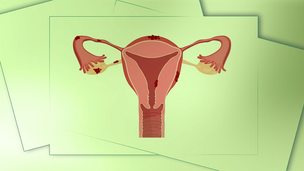 Livmoder med endometrios.