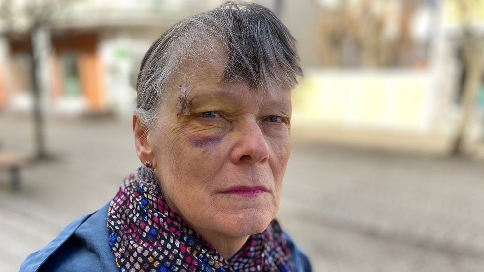 Närbild på Ingers ansikte som har sår och är gult och blått.