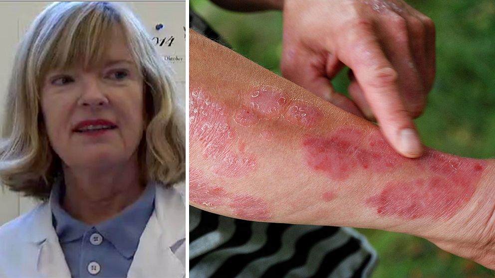 Hudsjukdomen psoriasis, som länge ansetts livslång, kan läka ut och det går att leva med den utan symptom, menar professor Mona Ståhle.