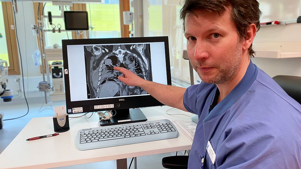 Läkaren Lars Falk pekar på en röntgenbild av ett par lungor. I bakgrunden syns sjukhusrummet.