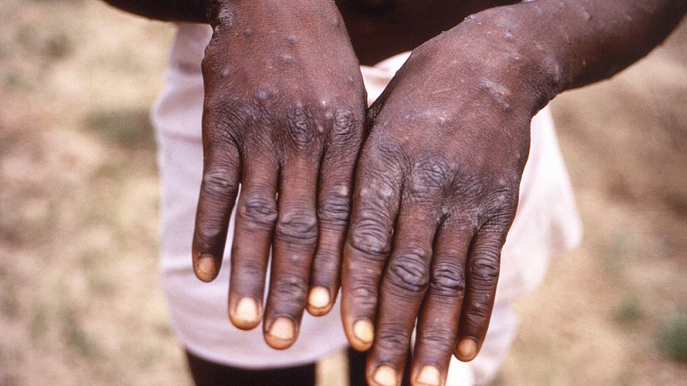 Bild från 1997 när man undersökte ett utbrott av apkoppor i Kongo-Kinshasa, dåvarande Zaire. Bilden visar en patients händer.