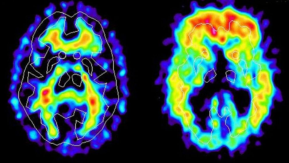 Hjärnan har förändrats långt innan Alzheimers sjukdom bryter ut hos en människa. Nästan 20 år tidigare drabbas hjärnan av inflammatoriska förändringar som tycks vara kopplade till sjukdomen.