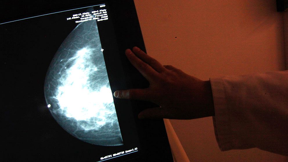 Röntgenbild från mammografiundersökning