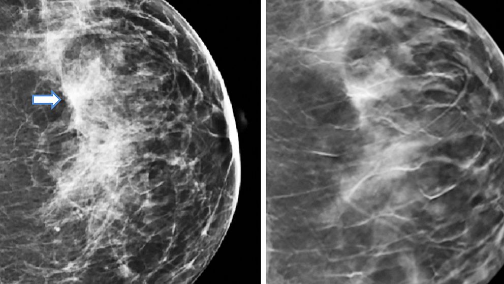 DBT, tomosyntes , 3D mammografi