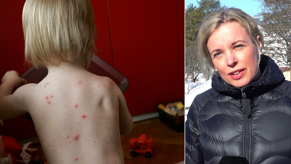 Kollage: Till vänster ett barn med vattkoppor som sitter med ryggen mot kameran. Till höger Västerbottens biträdande smittskyddsläkare Therese Thunberg. Hon har ljust uppsatt hår och svart vinterjacka.