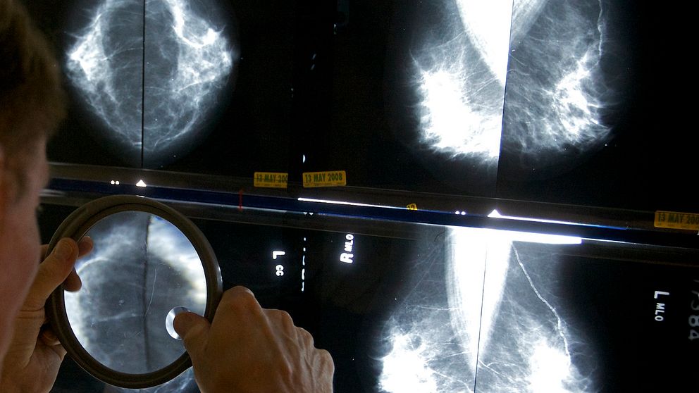 Läkare som tittar på röntgenbilder från en mammografi.