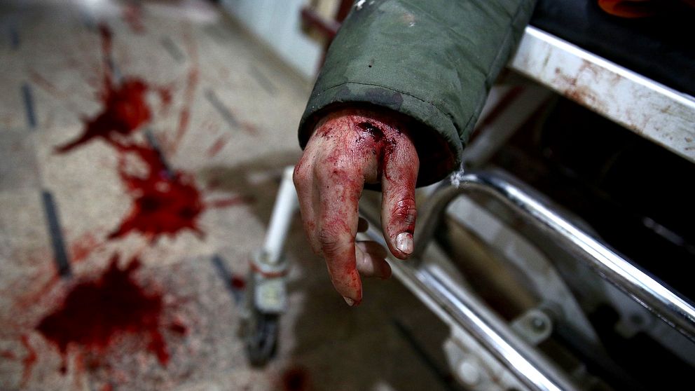 En skadad man på syriskt sjukhus blöder från handen.