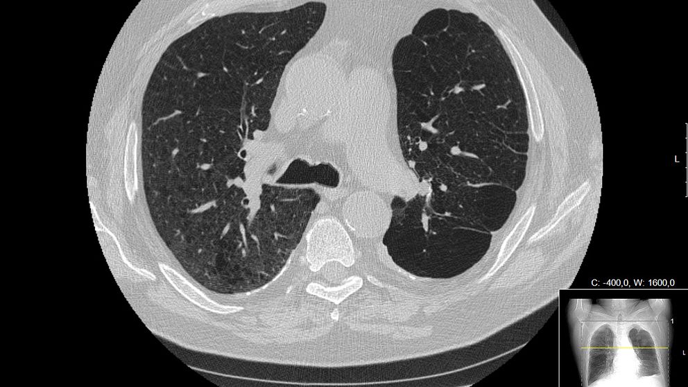 Lungor med KOL jämfört med friska lungor (mindre bilden).