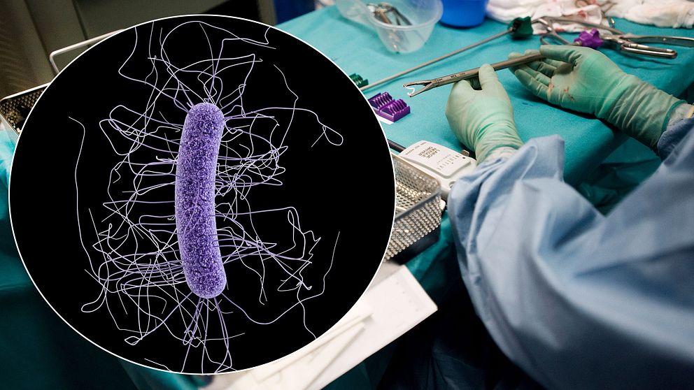 Arkivbild: En man drabbades av en allvarlig infektion av clostridiumbakterier i ett sår.