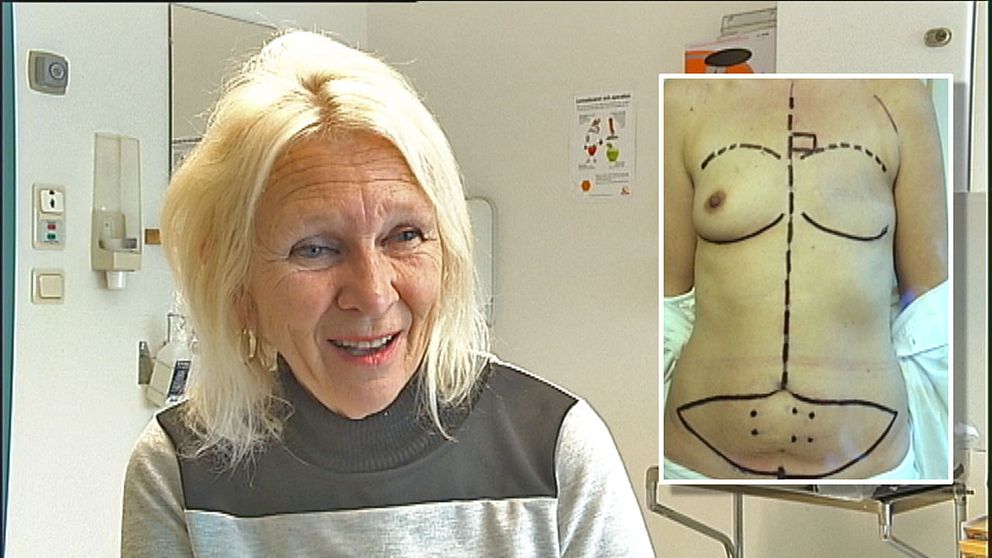 Heelna Cewers slapp bröstimplantat. Bröstet konstruerades av kroppseget material.
