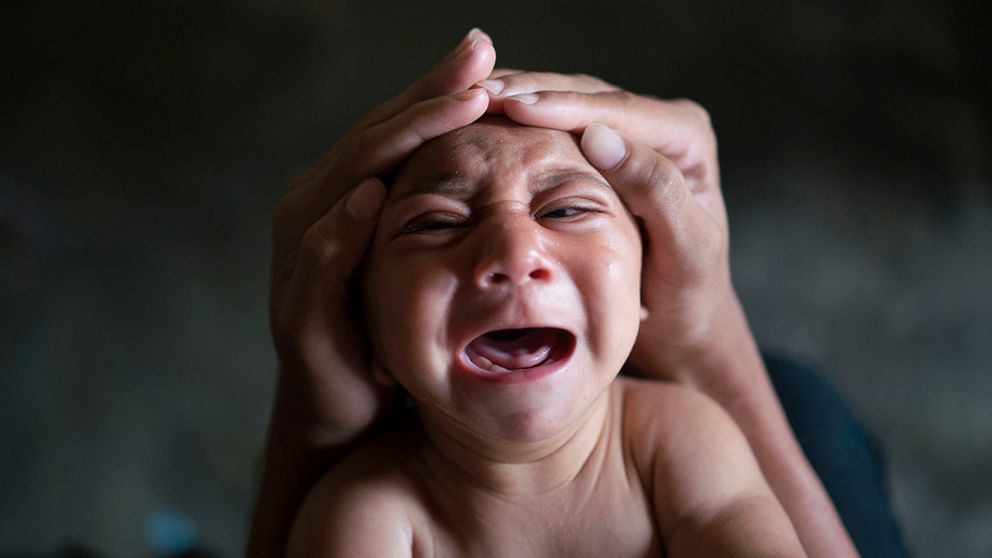 Bild på barn som drabbats av fosterskadan mikrocefali.