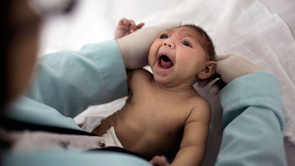 Forskarna är nu överens om att zikaviruset kan orsaka mikrocefali, det vill säga när barnet föds med onormalt litet huvud. Tillståndet innebär ibland, men inte alltid, att barnet får svåra handikapp senare i livet.