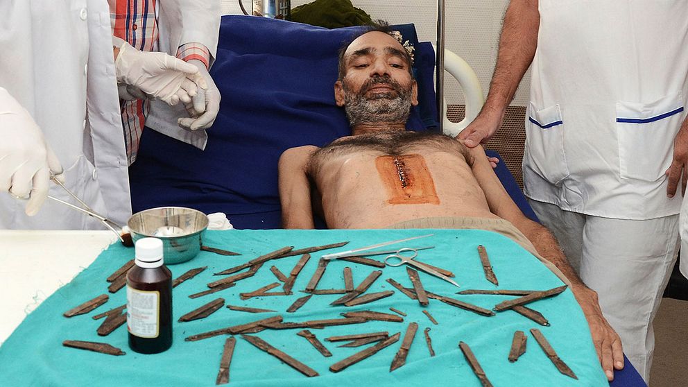 Den 42-årige patienten och de knivar som läkarna avlägsnat från hans mage.