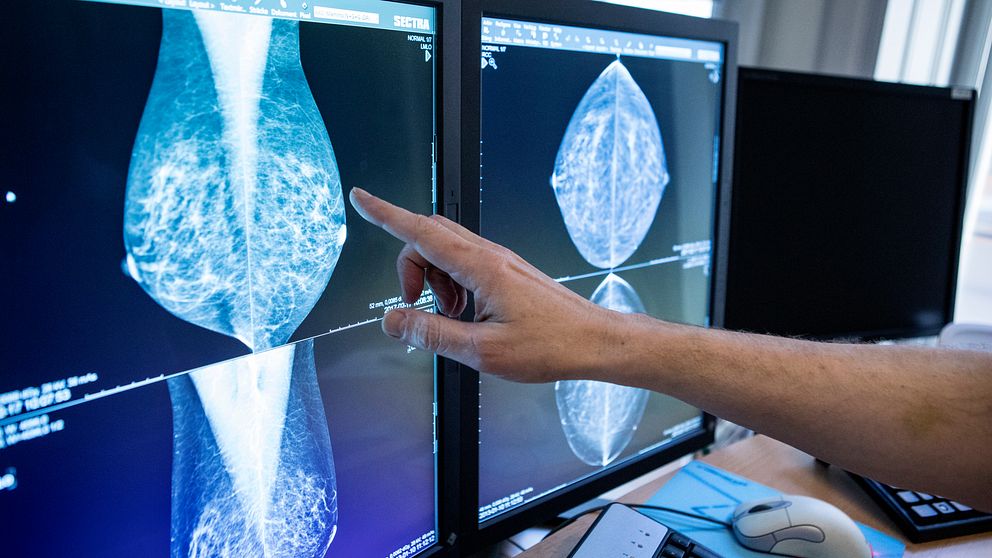 Läkare granskar mammografiresultat på två datorskärmar.