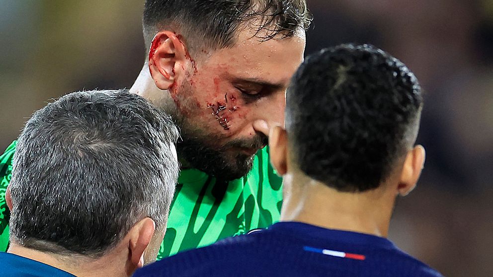 Gianluigi Donnarumma fick tillfälligt häfta ihop sitt sår efter att ha fått Monacobackens dobbar i ansiktet.