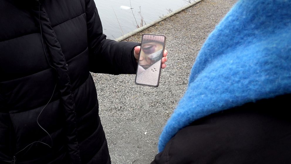 En tvååring fick efter en olycka på Bergviks förskola i Södertälje åka in till akuten med allvarliga skador. På en mobil visas skadorna upp.