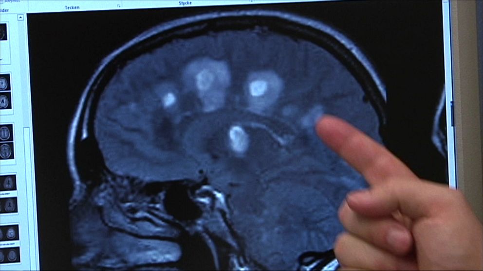 En person pekar på en MR-bild av en hjärna som visas på en datorskärm. Bilden visar olika ljusa områden som representerar anatomiska strukturer eller potentiella avvikelser i hjärnan.