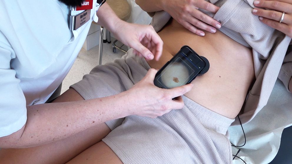 ett läkarbesök på hudmottagning – läkaren undersöker en leverfläck på en mage som syns i förstoring