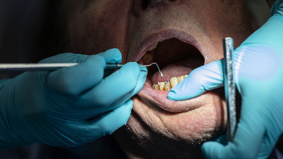 Tandläkares händer arbetar i en öppen mun.